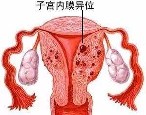 汉中华西妇产医院|女性患子宫内膜异位症的症状