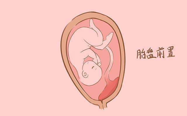 汉中华西妇产医院|关于前置胎盘与前壁胎盘的区别