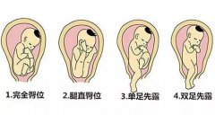 华西科普丨待产妈妈进，胎儿臀位别害怕！
