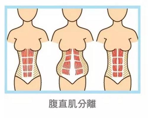 汉中华西妇产医院|产后腹直肌分离多少算正常范围内？