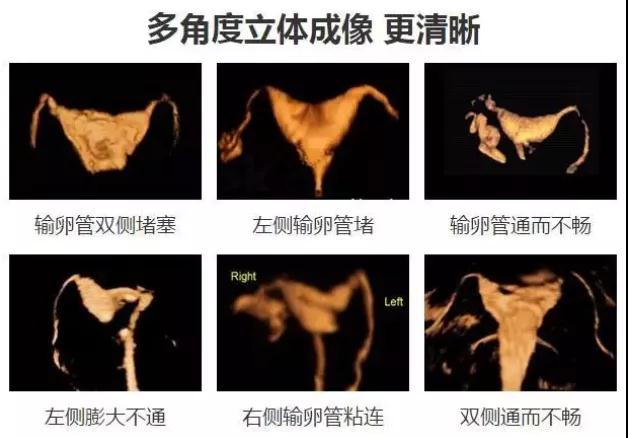 输卵管超声造影技术——让迎接宝宝的路畅通无阻！